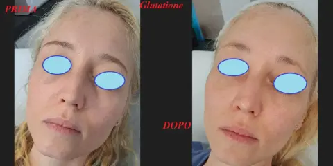 Prima e dopo un trattamento di glutatione per un miglioramento visibile del risultato peeling chimico.