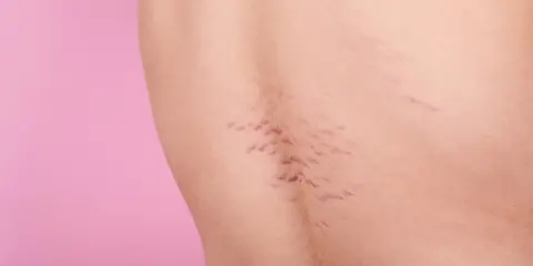 Pelle con smagliature viola, segni di crescita o cambiamenti corporei, su sfondo rosa.