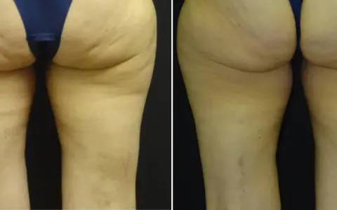 Gambe prima e dopo VelaShape: la pelle appare più liscia e tonica, con una riduzione visibile della cellulite.