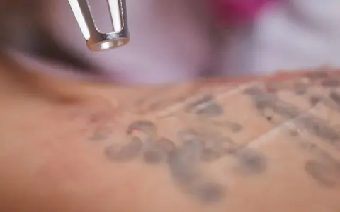 Laser che rimuove un tatuaggio, mostrando la pelle in fase di guarigione.