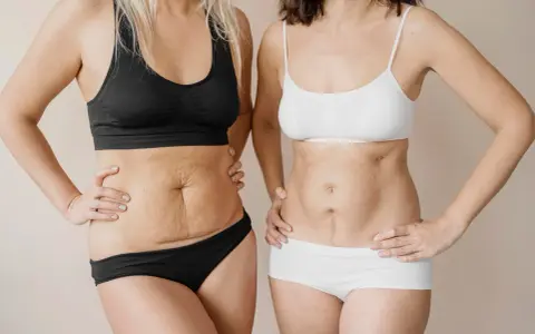 Due donne mostrano i loro addomi, uno con smagliature e l'altro con una cicatrice, un confronto prima e dopo un mommy makeover.