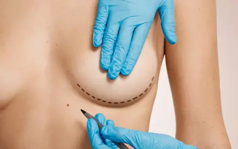 Mani guantate disegnano il contorno del seno per un intervento. Le cicatrici del seno rifatto sono un ricordo del percorso di trasformazione.