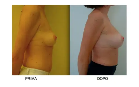 Confronto seno rifatto prima e dopo: immagine mostra il profilo di una donna, prima e dopo un intervento di mastoplastica additiva, evidenziando il cambiamento.