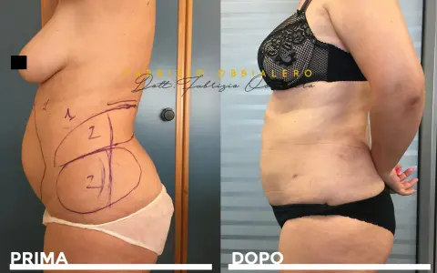 Addome prima e dopo liposcultura: il fianco sinistro mostra le marcature pre-operatorie, il fianco destro il risultato.
