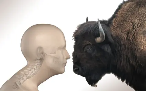 Profilo umano con scheletro cervicale e bisonte. Come eliminare la gobba del bisonte?