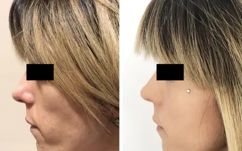 Prima e dopo lipofilling viso: il lato sinistro mostra un viso con contorni meno definiti, il destro un viso più armonioso. Esperienze negative da valutare.