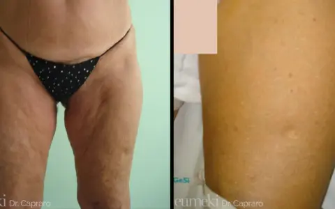 Lifting cosce: prima e dopo, con attenzione alle cicatrici e alla texture della pelle.