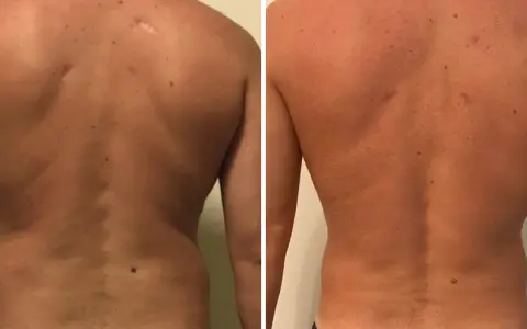 Risultati visibili di liposuzione schiena prima e dopo: la schiena appare più definita e liscia, con una riduzione del grasso accumulato.