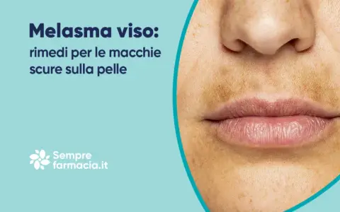 Primo piano del viso con melasma, evidenziando la zona baffetti scura e macchie sulla pelle. Rimedi per il melasma.
