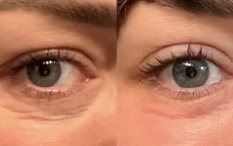Occhi prima e dopo peeling TCA: rughe attenuate e pelle più liscia.