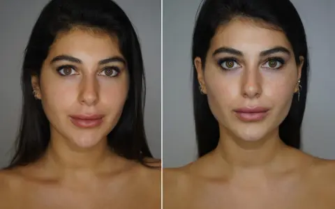 Prima e dopo: un volto femminile con labbra più piene e un contorno mascella definito, suggerendo un trattamento di filler mascella donna.
