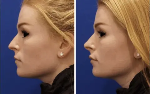 Profilo di donna prima e dopo rinofiller naso frontale. Il trattamento ha migliorato la linea del naso e del mento.