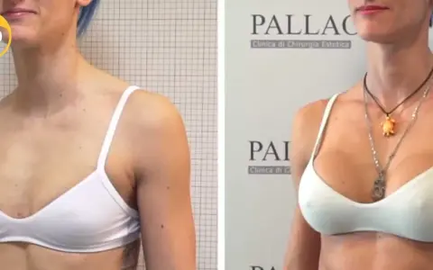 Prima e dopo: seno rifatto taglia 2, un risultato naturale e armonioso.