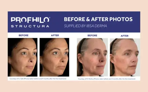 Profhilo Body: risultati prima e dopo. Due donne mostrano miglioramenti visibili della pelle dopo il trattamento.