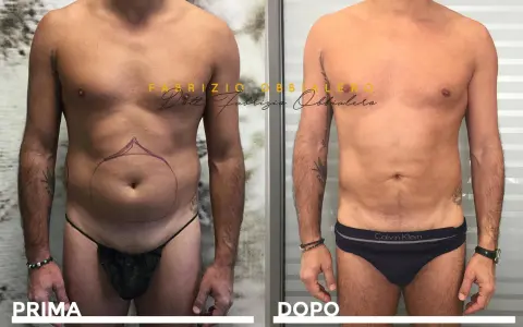 Prima e dopo liposuzione pube uomo. Addome più definito e tonico, con contorni migliorati.