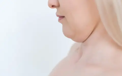 Primo piano del profilo di una donna con doppio mento, un'area che molte persone desiderano migliorare per capire come dimagrire sotto il mento.