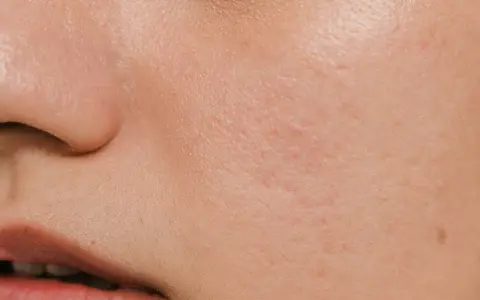 Pelle arrossata e screpolata, con piccole imperfezioni, tipica di un'ustione o un peeling chimico.