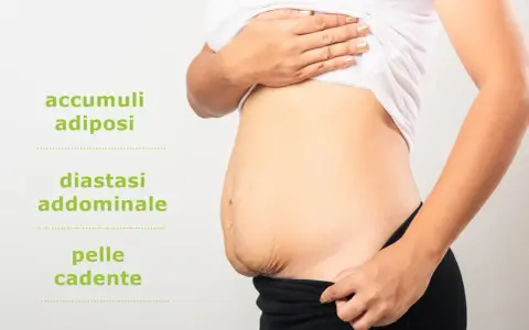 Addominoplastica cos'è: immagine mostra addome con accumuli adiposi, diastasi addominale e pelle cadente, condizioni trattabili.