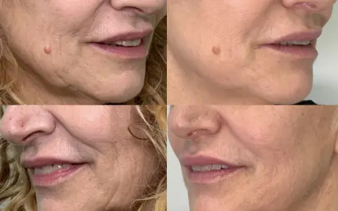 Punture di vitamine viso prima e dopo: la pelle appare più liscia e luminosa, con una riduzione delle rughe e un aspetto più giovane.
