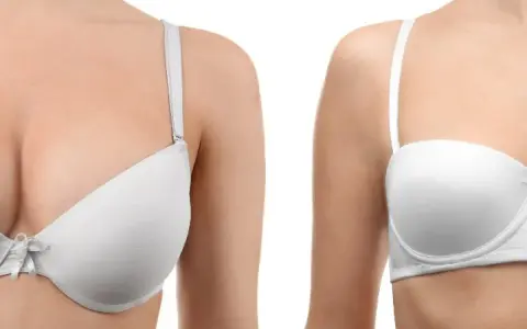 Primo piano di un seno rifatto taglia 4 a goccia, con un reggiseno bianco.