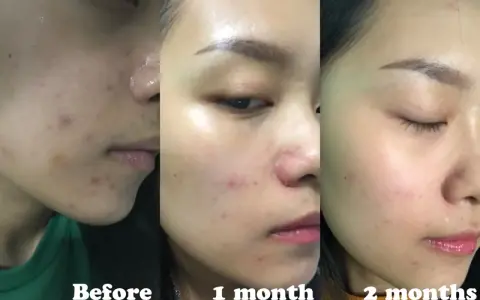 Acne migliorata con acido salicilico: prima, dopo 1 mese e dopo 2 mesi.