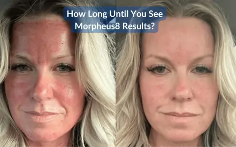 Prima e dopo Morpheus8: il volto arrossato e irritato solleva dubbi sui risultati.