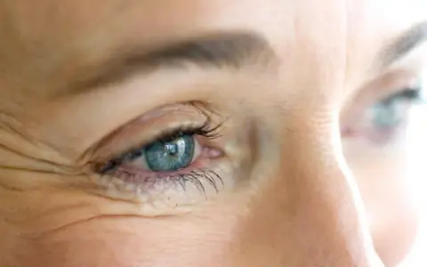 Occhio con evidenti zampe di gallina, un segno del tempo che il botox può attenuare per un aspetto più giovane.