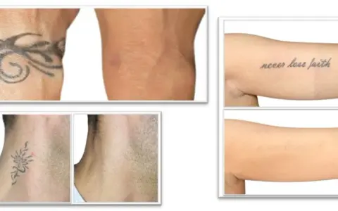Prima e dopo la rimozione tatuaggi: braccio con tatuaggio tribale e braccio senza, collo con tatuaggio floreale e collo senza, braccio con scritta "never lose faith" e braccio senza.