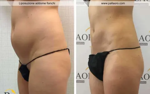 Addome e fianchi prima e dopo liposuzione. La silhouette è visibilmente più snella e definita.