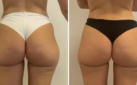 Lipofilling glutei prima e dopo: confronto visivo dei risultati. I glutei appaiono più voluminosi e armoniosi dopo il trattamento.