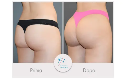 Risultati vaser lipo prima e dopo: glutei più voluminosi e scolpiti.
