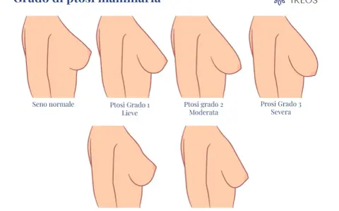 Illustrazione dei gradi di ptosi mammaria: seno normale, lieve, moderata, severa, pseudo ptosi e maldistribuzione. Il seno rifatto può diminuire nel tempo.