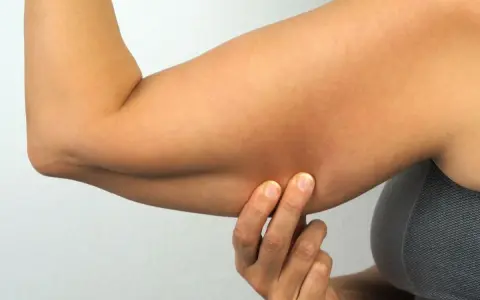 Braccia con pelle raggrinzita dopo dimagrimento, evidenziata da dita che pizzicano la cute.