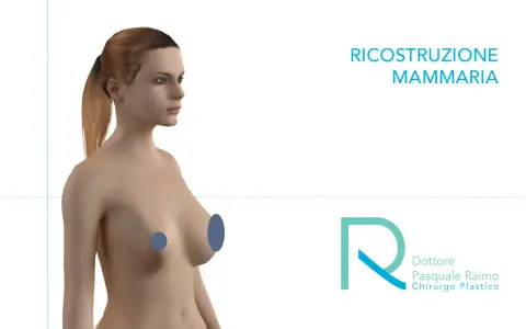Modello 3D di un torace femminile, con aree evidenziate per illustrare la mastectomia e la ricostruzione mammaria.