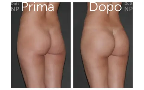 Prima e dopo gluteoplastica senza protesi: un risultato naturale e armonioso.
