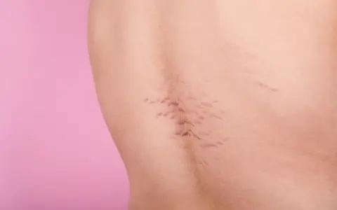 Pelle con smagliature viola, segni di crescita o cambiamenti corporei, su sfondo rosa.