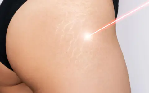 Laser treatment on skin with smagliature, showing a path to come eliminare le smagliature.