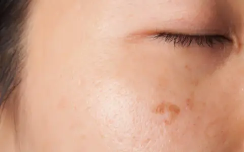 Primo piano del viso con macchie scure sulla pelle, alcune più evidenti vicino all'occhio.