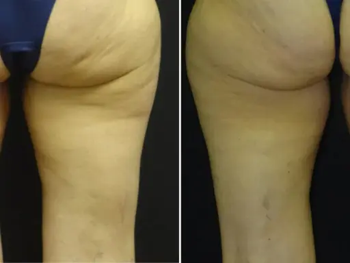 Gambe prima e dopo VelaShape: la pelle appare più liscia e tonica, con una riduzione visibile della cellulite.