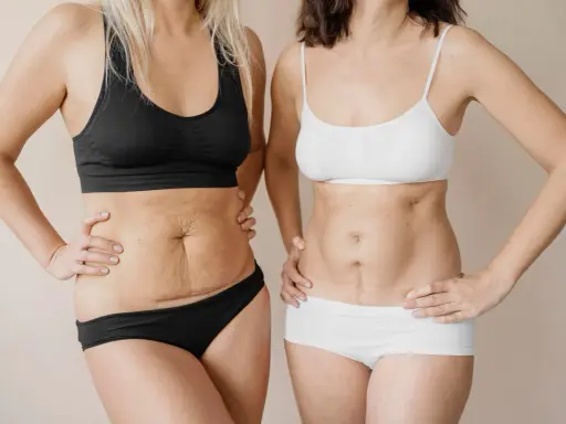Due donne mostrano i loro addomi, uno con smagliature e l'altro con una cicatrice, un confronto prima e dopo un mommy makeover.