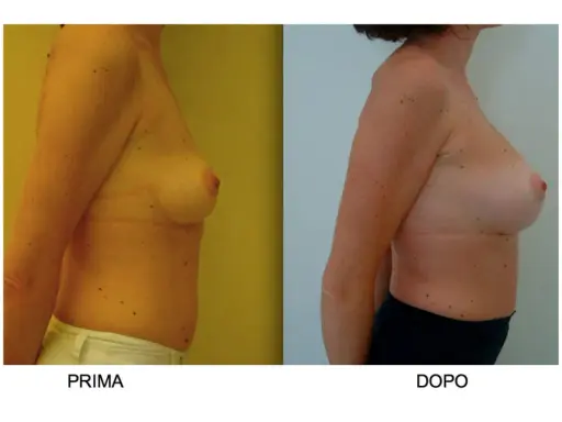 Confronto seno rifatto prima e dopo: immagine mostra il profilo di una donna, prima e dopo un intervento di mastoplastica additiva, evidenziando il cambiamento.
