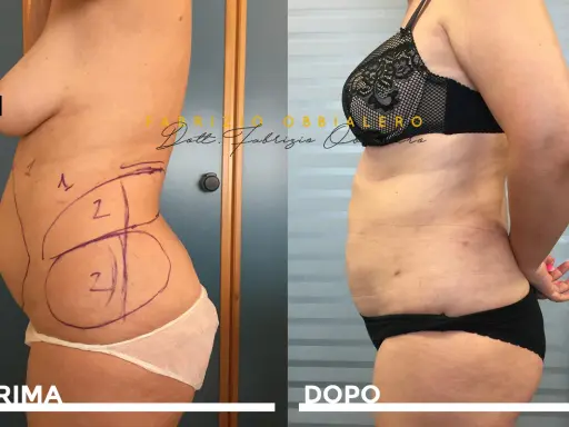 Addome prima e dopo liposcultura: il fianco sinistro mostra le marcature pre-operatorie, il fianco destro il risultato.