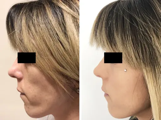 Prima e dopo lipofilling viso: il lato sinistro mostra un viso con contorni meno definiti, il destro un viso più armonioso. Esperienze negative da valutare.