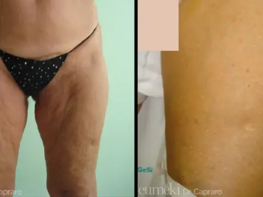 Lifting cosce: prima e dopo, con attenzione alle cicatrici e alla texture della pelle.