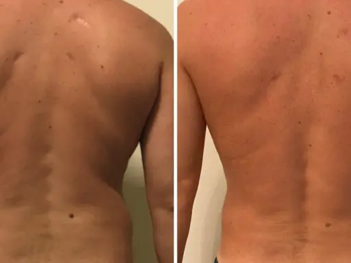 Risultati visibili di liposuzione schiena prima e dopo: la schiena appare più definita e liscia, con una riduzione del grasso accumulato.
