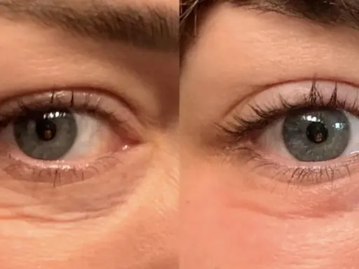 Occhi prima e dopo peeling TCA: rughe attenuate e pelle più liscia.