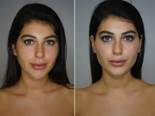 Prima e dopo: un volto femminile con labbra più piene e un contorno mascella definito, suggerendo un trattamento di filler mascella donna.