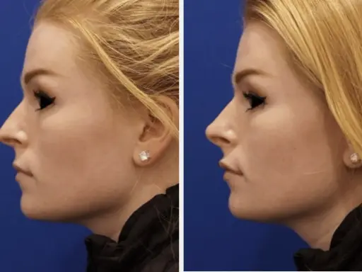 Profilo di donna prima e dopo rinofiller naso frontale. Il trattamento ha migliorato la linea del naso e del mento.