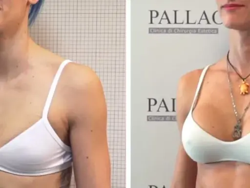 Prima e dopo: seno rifatto taglia 2, un risultato naturale e armonioso.