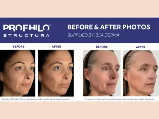 Profhilo Body: risultati prima e dopo. Due donne mostrano miglioramenti visibili della pelle dopo il trattamento.